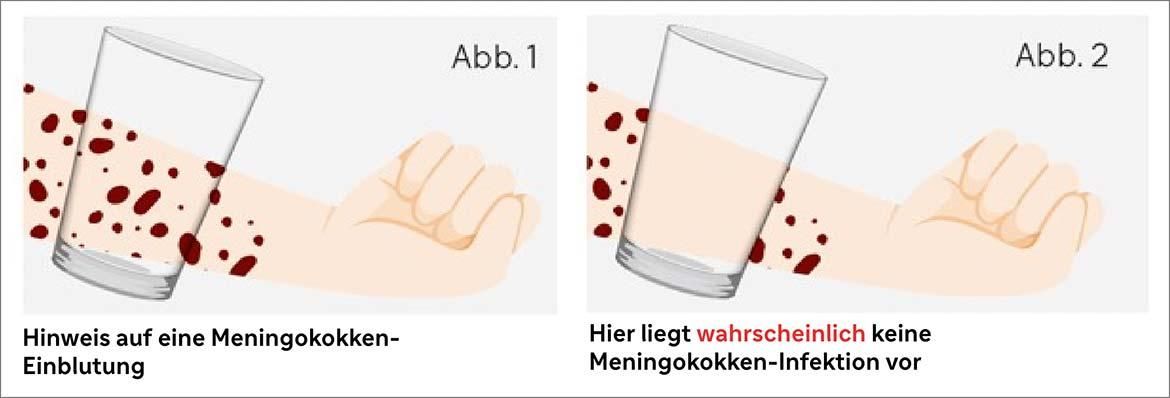 Glastest: ein einfacher Check zum Erkennen einer Meningokokken-Erkrankung